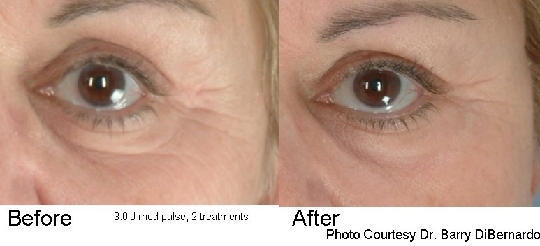 laser treatment for wrinkles York