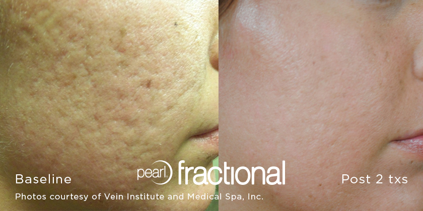 Remove acne craters on face in Aurora