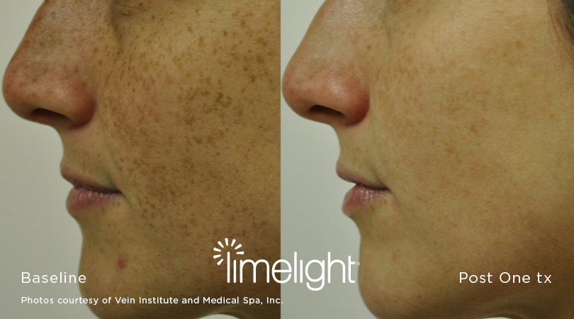 laser treatment gets rid of liver spots on face York
