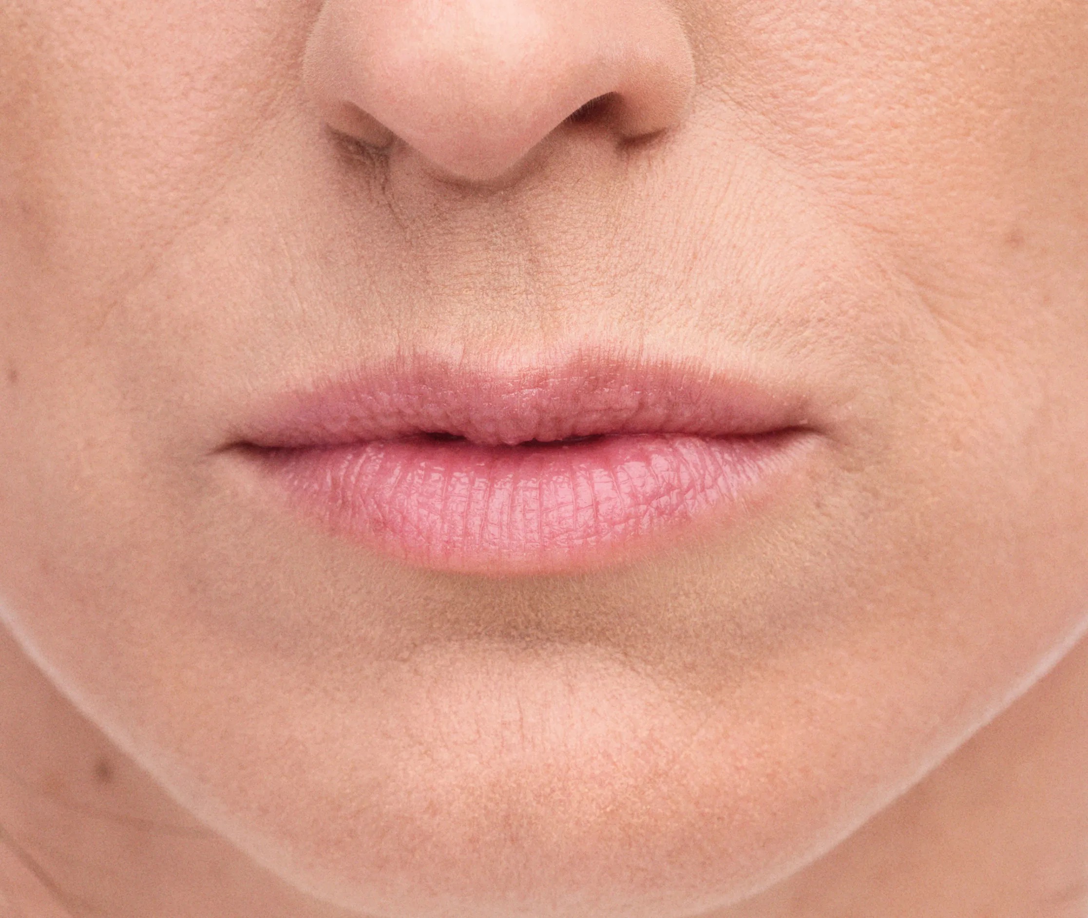 lip filler treatment for wrinkles York